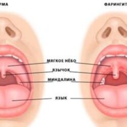Фарингит: фото, симптомы, лечение; острый, хронический