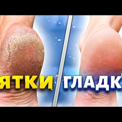 ПЯТКИ гладки!