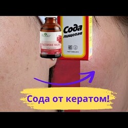 СОДА! Убираем кератомы своими руками. Ровный тон кожи без пятен.