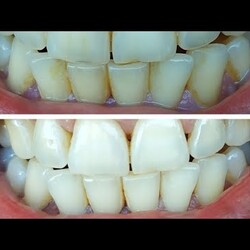 Как отбелить зубы, убрать зубной налет и зубной камень в домашних условиях. Чистка зубов без соды!