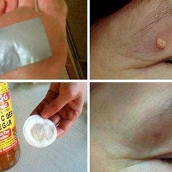 избавиться от бородавок, чёрных точек, родинок и папиллом