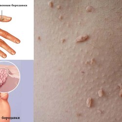 Вы навсегда уничтожите все бородавки и папилломы, применяя эти домашние средства! Быстро и просто!