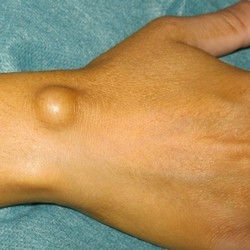 ЛЕЧИМ ЖИРОВИК