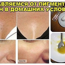 ИЗБАВЛЯЕМСЯ ОТ ПИГМЕНТНЫХ ПЯТЕН