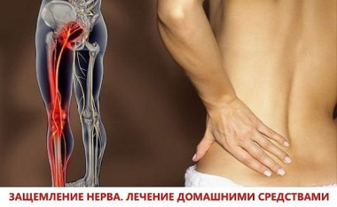 ЗАЩЕМЛЕНИЕ НЕРВА. ЛЕЧЕНИЕ ДОМАШНИМИ СРЕДСТВАМИ