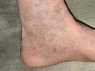 Домашнее лечение варикоза