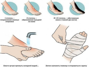 ЛЕЧЕНИЕ ОЖОГОВ - ПЕРВАЯ ПОМОЩЬ! 12 ХОРОШИХ СОВЕТОВ!