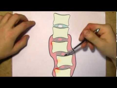 Что такое остеохондроз на самом деле