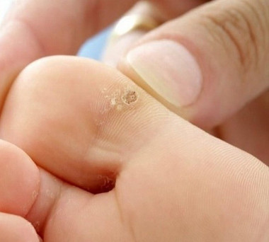 от бородавок и мозолей и травы