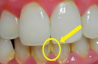 Как убрать зубной камень 