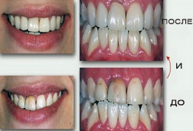 ЛЕЧЕНИЕ ЗУБОВ БЕЗ ПЛОМБИРОВАНИЯ аир прополис