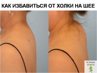 КАК ИЗБАВИТЬСЯ ОТ ХОЛКИ НА ШЕЕ