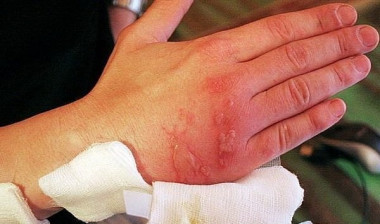 ЛЕЧЕНИЕ ОЖОГОВ- ПЕРВАЯ ПОМОЩЬ!!! 12 ХОРОШИХ СОВЕТОВ!!!